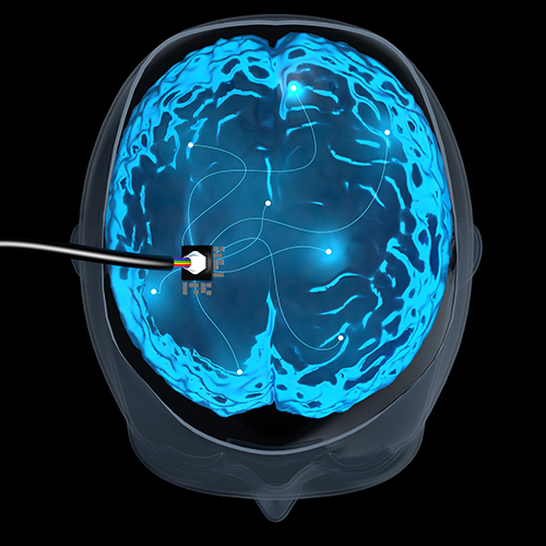 Innovative Advances in Stroke Recovery Show Early Promise